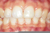 Unhealthy Lower Gums Image