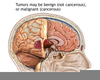 Brain Cancer Diagram Image