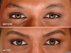 Brow Bone Growth Image