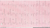 Premature Ventricular Contractions Image