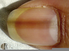 Benign Melanonychia Image