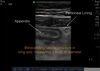 Graded Compression Ultrasound Image