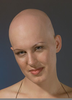 Alopecia Totalis Image