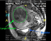 Endometrium Side View Image