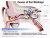 Conductive Deafness Image