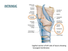 Lateral Cricoarytenoid Image