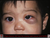 Capillary Hemangioma Eye Image