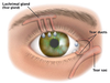 Blocked Tear Duct Image