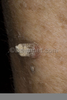 Actinic Keratosis Horn Image