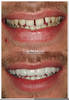 Gap Teeth Veneers Image