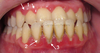 Periodontitis Symptoms Image