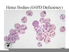 G Pd Deficiency Image