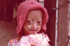 Progeria Adalia Rose Image