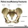 Pelvic Fracture Anatomy Image