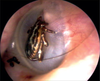 Eardrum Tip Image