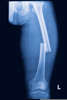 Transverse Fracture Image