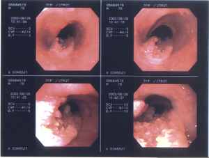 Esophageal Adenocarcinoma Image