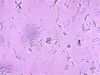 Crystals Urine Oxalate Image