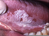 Leukoplakia Cheek Image