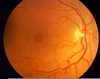 Macular Hole Image