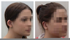 Otoplasty Headband Image